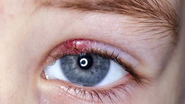болезни глаз